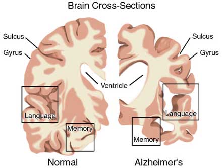 Alzheimer Home Remedy – ferma l’Alzheimer nelle sue fasi iniziali con trattamenti naturali