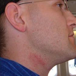 Bruciatura da rasoio -sintomi, cause e altri fattori di rischio