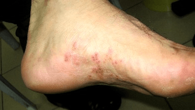 Infezione fungina: tipi, sintomi e altri fattori di rischio