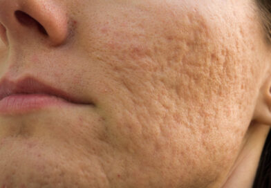 Cicatrici da acne: tipi, cause e altri fattori di rischio