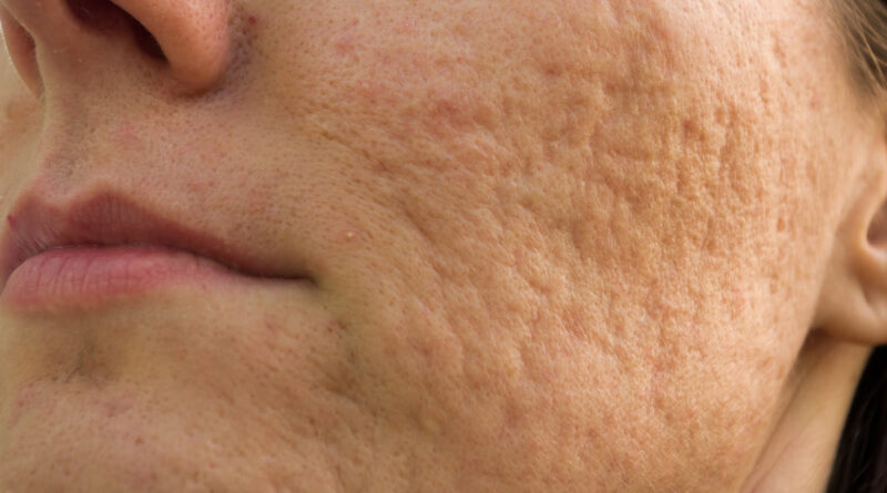 Cicatrici da acne: tipi, cause e altri fattori di rischio