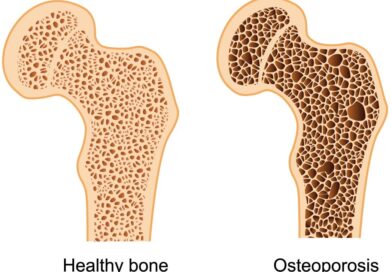 Densità ossea: cause e altri fattori di rischio correlati